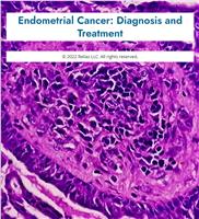 Endometrial Cancer: Diagnosis and Treatment